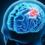 Brain Cancer : The Causes and Treatments